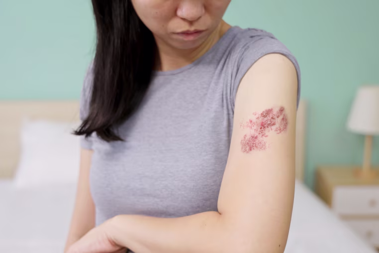 A woman with a shingles rash on her upper arm. 