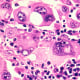 Human metastatic melanoma cells