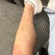 The rash on Noa Umbaugh’s leg/stomach.