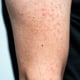 Dermatitis rash viral disease with immunodeficiency on arm of young adult