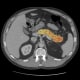 The REDMOD AI model analyzes a CT scan to detect early tissue changes associated with pancreatic cancer.