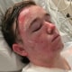 Jacob Smith recovers in the UC Davis ICU burn unit after police say a coworker at a McDonald's in Yuba City, Calif., threw hot liquid on him.