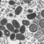 An electron microscope image of monkeypox virions, left, and spherical immature virions, right, obtained from a sample of human skin.