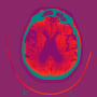 Axial Section scan of the brain of a patient affected By Alzheimer's. 