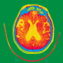 Scan of the brain of a patient affected by Alzheimer's disease.