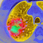 Lung cancer MRI.