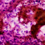 FNAC of lymph nodes tissue Cytology microscopic 100x show Microbacterium Tuberculosis TB. Lymph node TB.