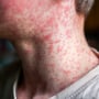 Skin covered with measles rash.