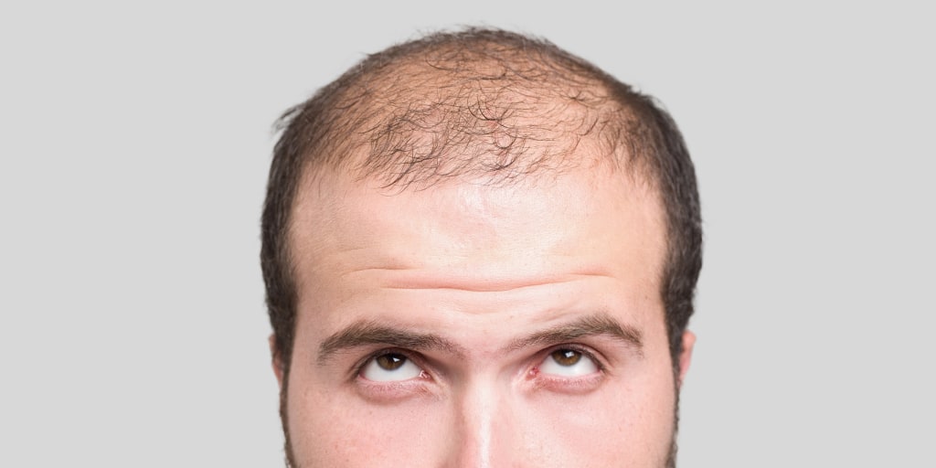 Hair Loss Drug Propecia Carries Risk of Losing Something Else