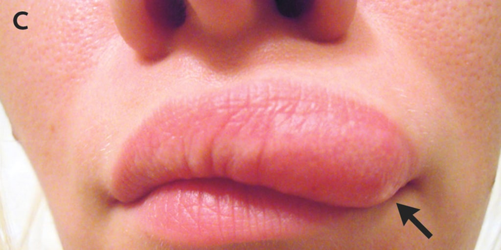 Mosquito Bite On Lip Symptoms - Infoupdate.org