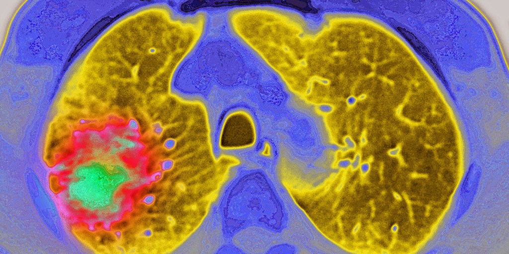 glp 1 and throwing up What Helps Nausea from GLP-1: Proven Relief Strategies glp 1 and throwing up What Helps Nausea from GLP-1: Proven Relief Strategies