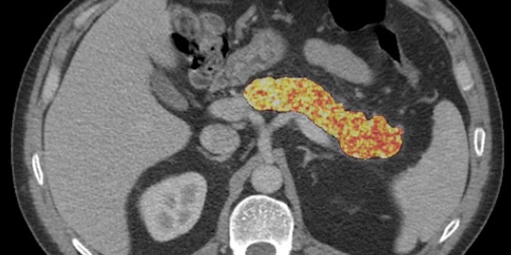 AI Deteksi Kanker Pankreas Dini Sebelum Tumor Terlihat di CT Scan