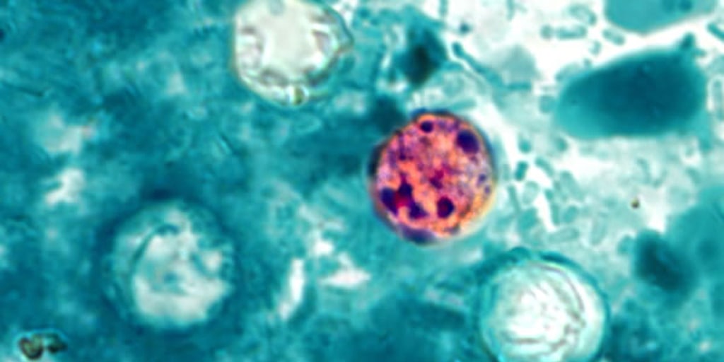 What is cyclosporiasis? Symptoms, total cases, map and latest as parasite outbreaks reach 31 states