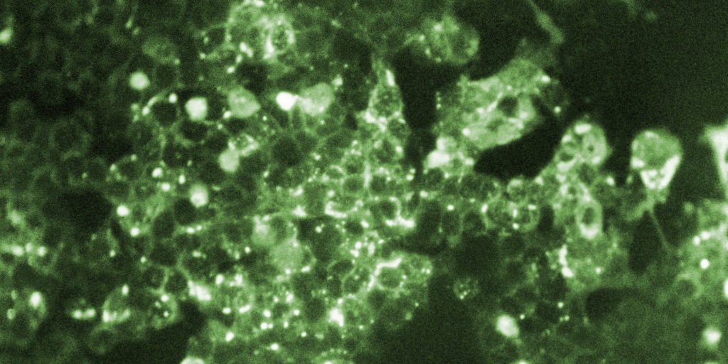 Pennsylvania health officials report the death of an unvaccinated resident of Lancaster County who tested positive for measles, the fifth measles-related death in the state since August.