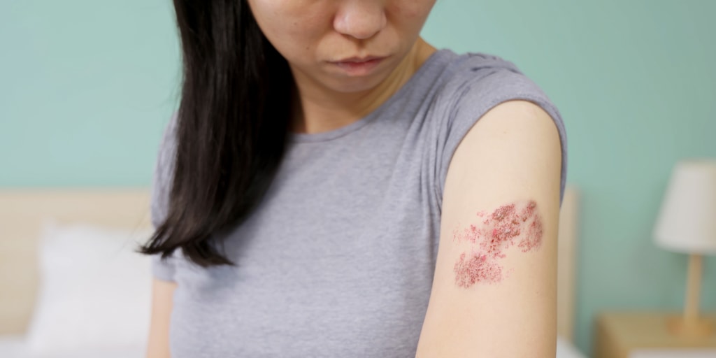 People 34 and younger may be less likely to develop shingles than previous generations, new data suggests, thanks in part to widespread chickenpox vaccination.