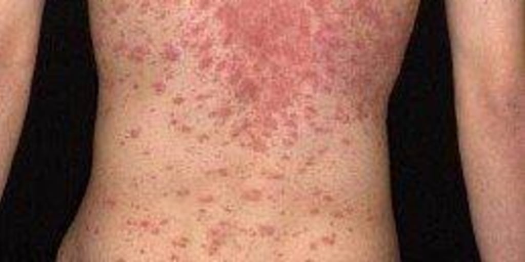 Happy holidays! Here is a rash shaped like a Christmas tree