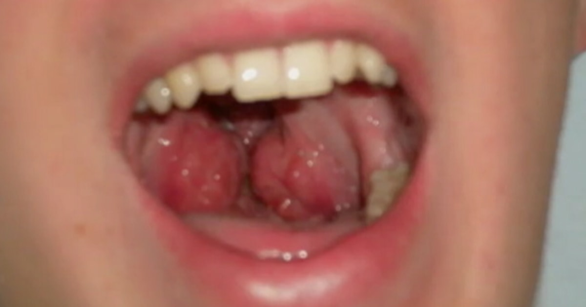 How Much Does It Cost To Get Your Tonsils Removed In