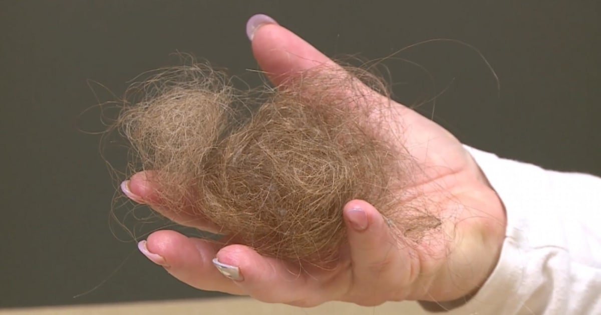 Covid hair loss Doctor explains Wisconsin woman's side effect