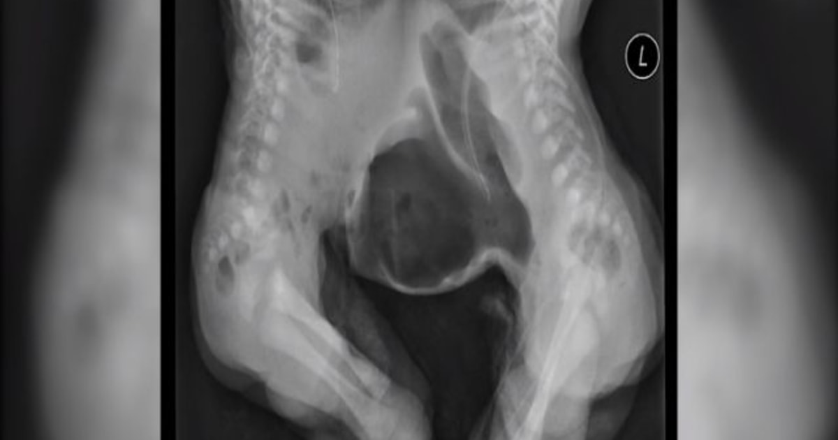 Conjoined Twins Separated