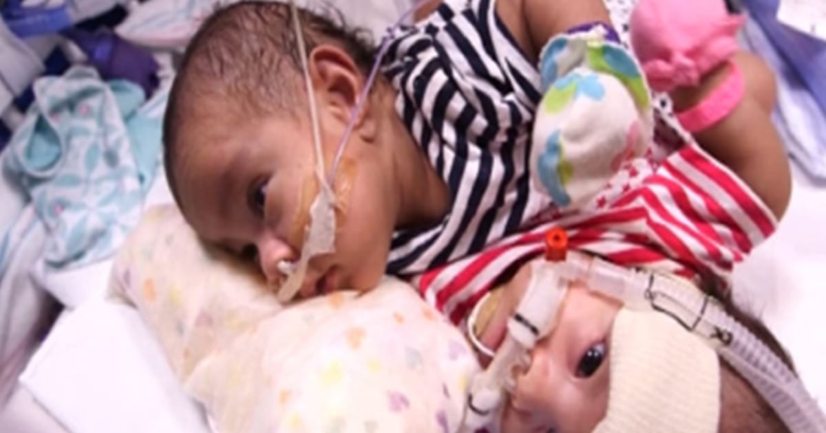 Conjoined Twins Set For Surgery