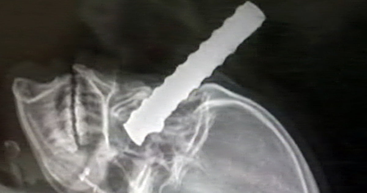 Man survives after steel rod pierces skull