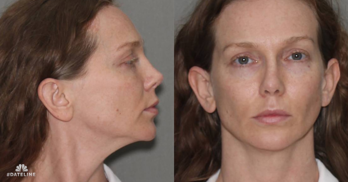 More on Kaitlin Armstrong's plastic surgery in Costa Rica