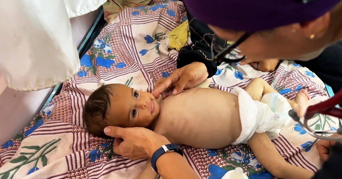 &lsquo;Just the skin over the bone&rsquo;: Babies suffer severe malnutrition in Gaza