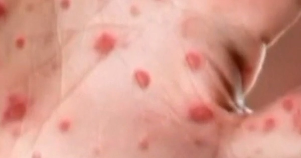 A whole bunch of scholars quarantine amid measles outbreaks