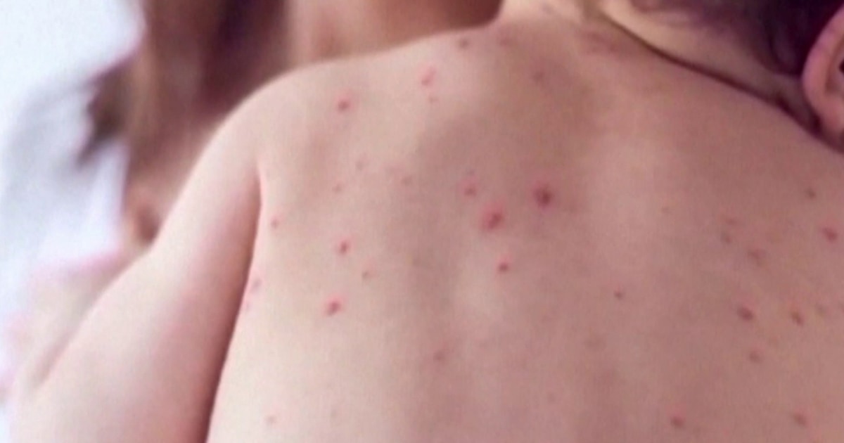 South Carolina measles cases hit new high