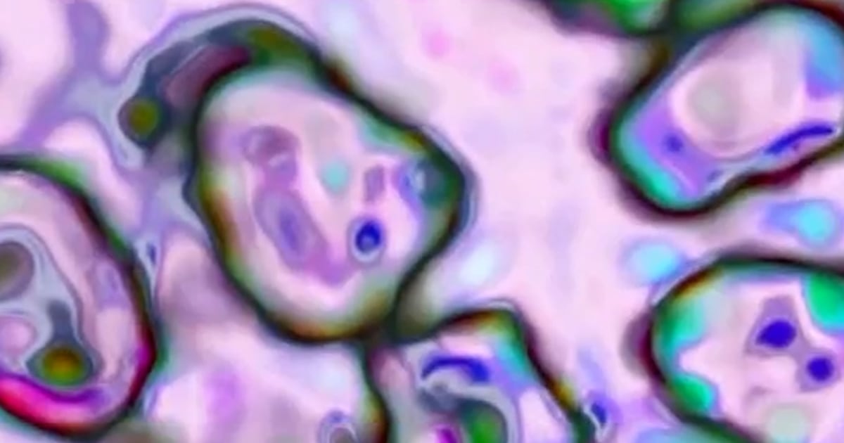 South Carolina’s Measles Outbreak Declared Over - Beritaja