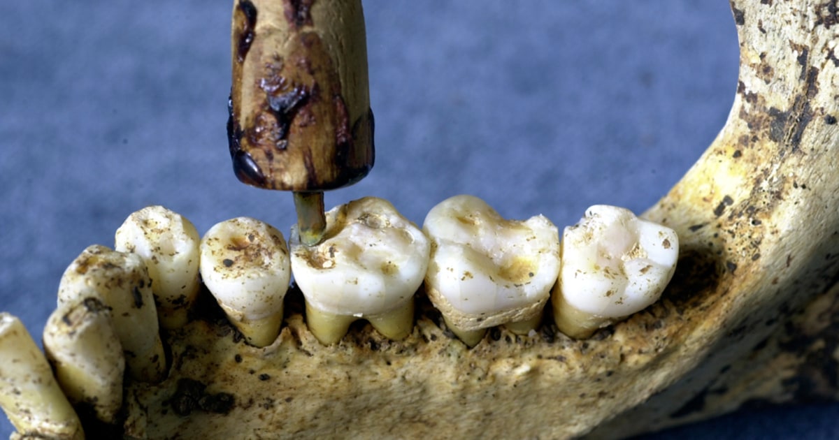 Dig uncovers ancient roots of dentistry