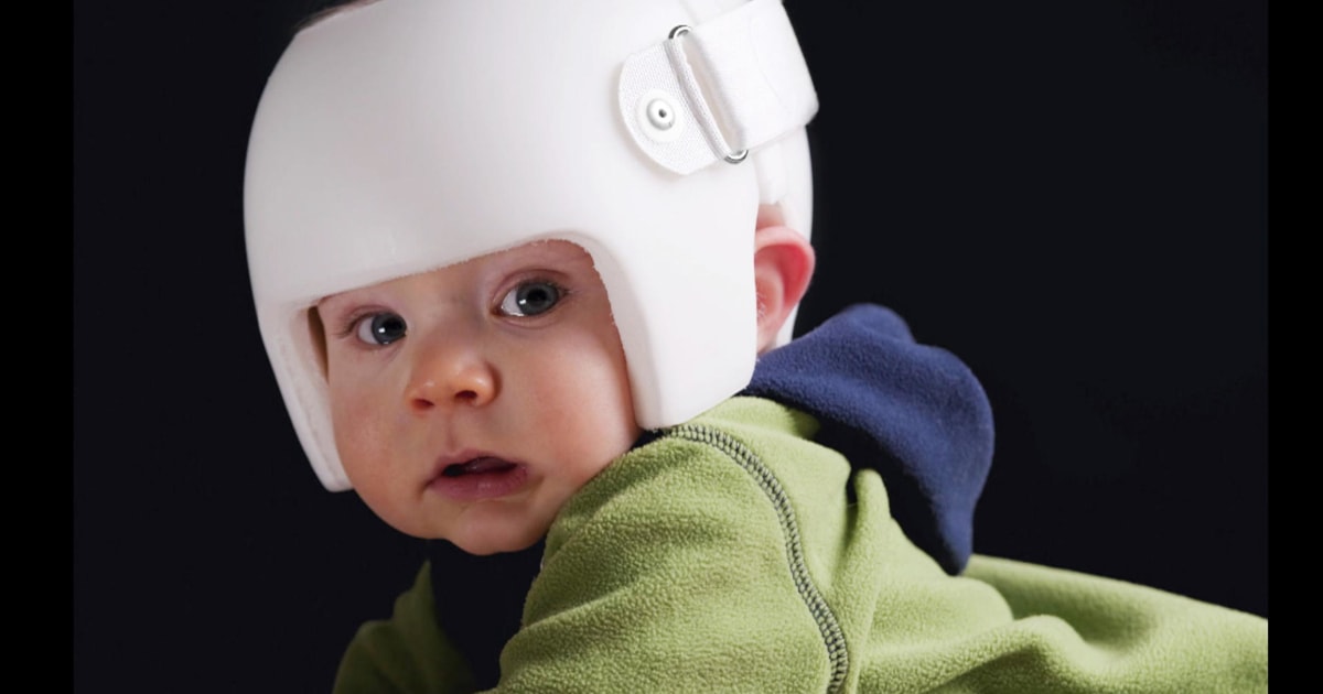 Do Baby Helmets Correct Skull Formation?