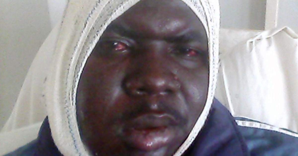 Nigerian Christian Shot In The Face By Boko Haram Reveals Ordeal