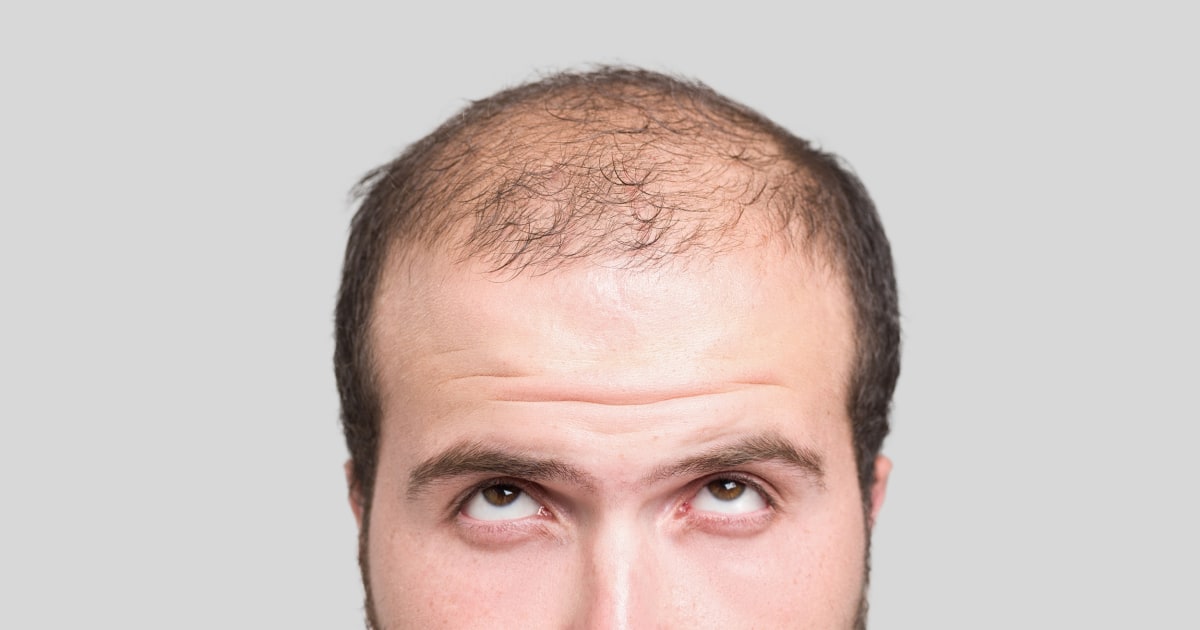 Hair Loss Drug Propecia Carries Risk of Losing Something Else