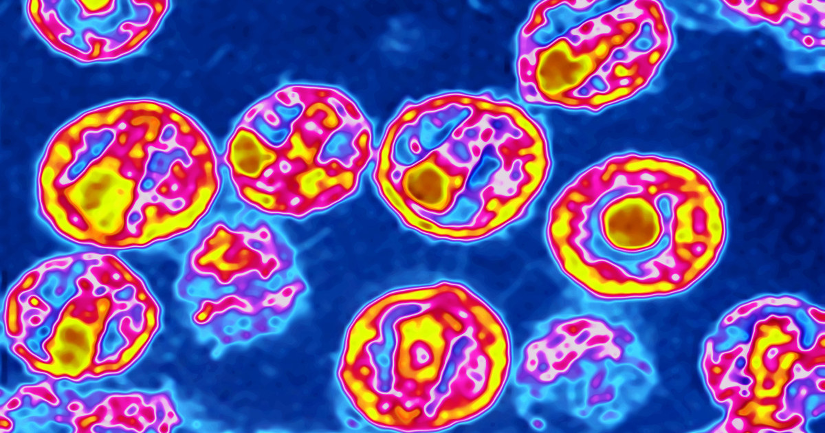 'Cured' HIV Baby is Infected, Doctors Find