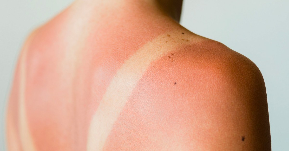 9 best sunburn treatments according to dermatologists