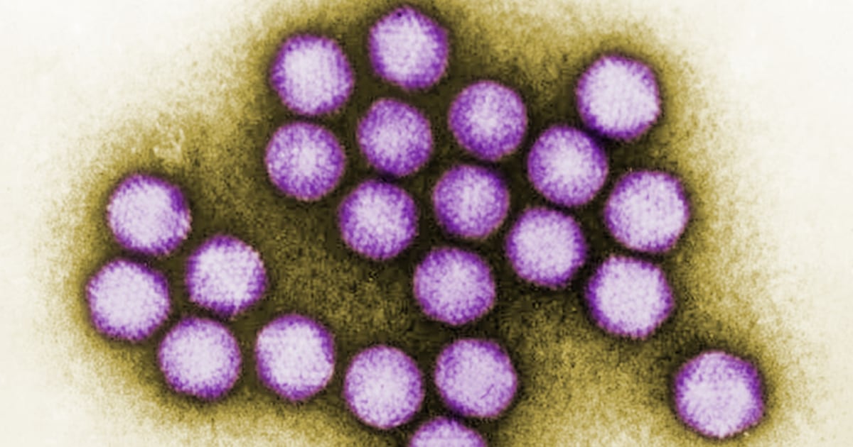The CDC report found no Covid link in cases of childhood hepatitis in Alabama.
