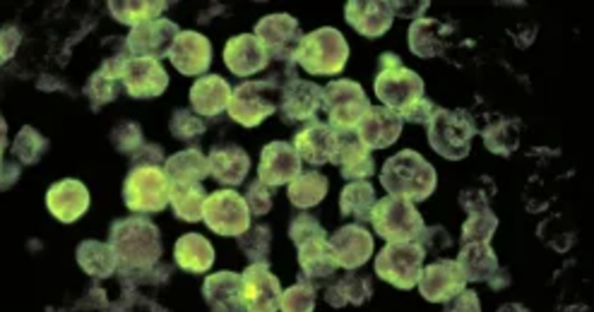 Iowa beach closed after tourist contracted brain-eating amoeba