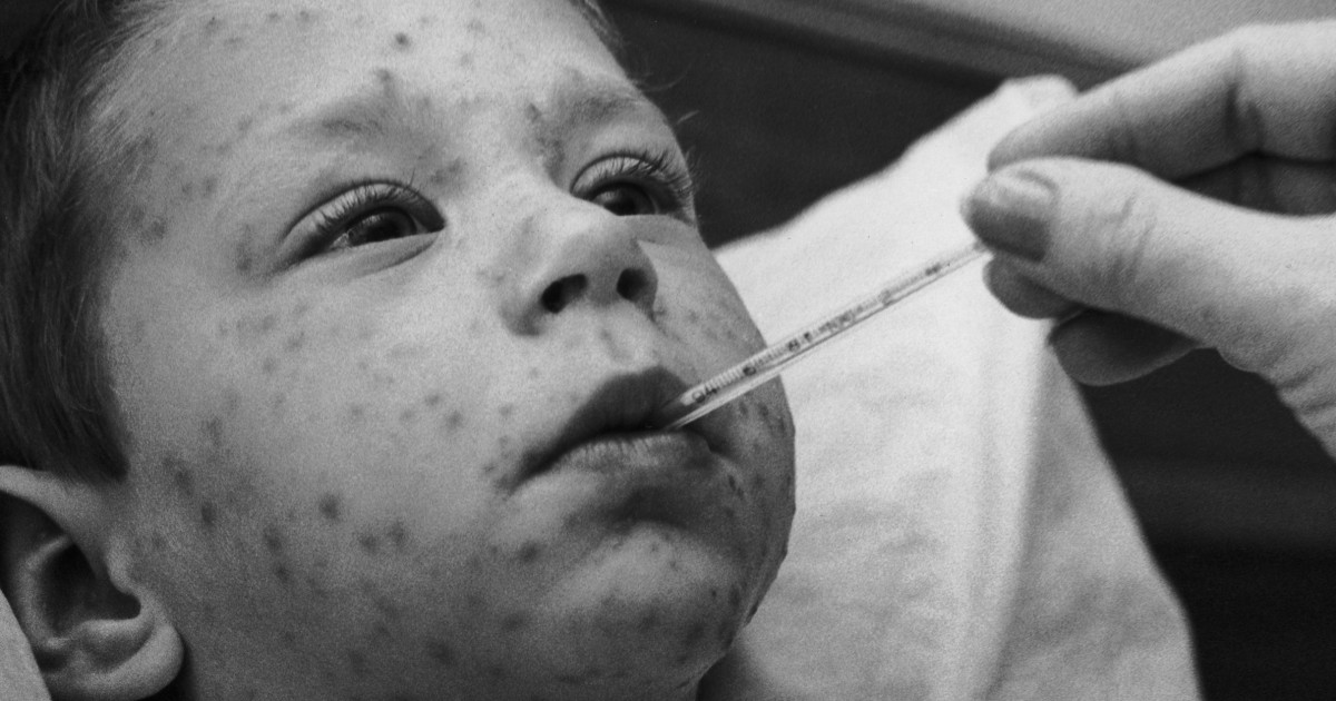 Chickenpox vaccine has pretty much wiped out extreme ailment from the virus