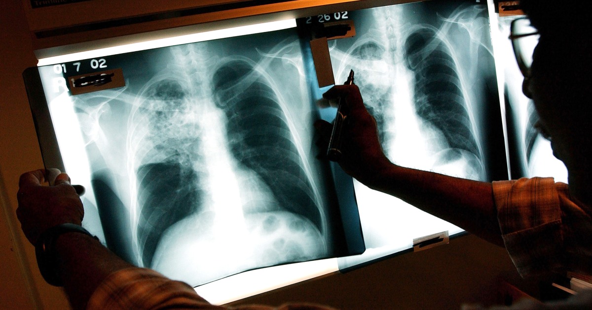 Why tuberculosis cases rose recently after decades of decline