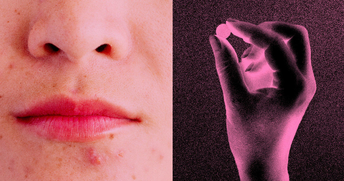 Защо дерматолозите предписват на жените лекарство за кръвно налягане за акне?