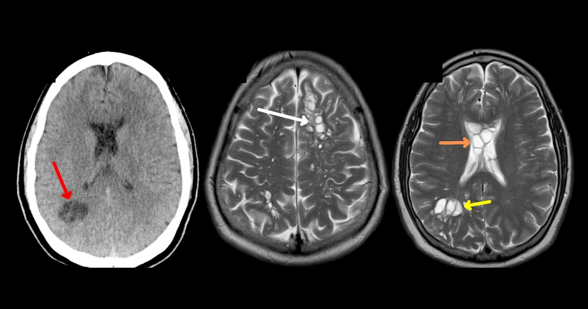 Човек открива мигрена, причинена от мозъчни тении, недостатъчно сготвеният бекон може да е виновник