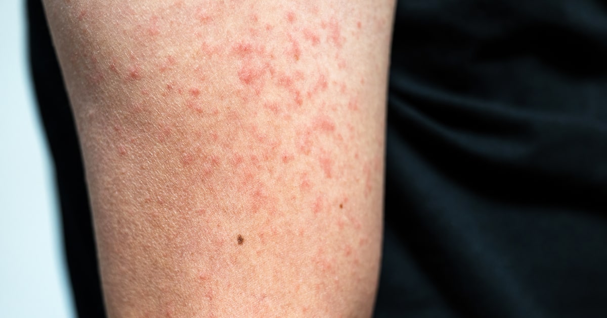 U.S. measles cases this year have already surpassed the 2023 total
