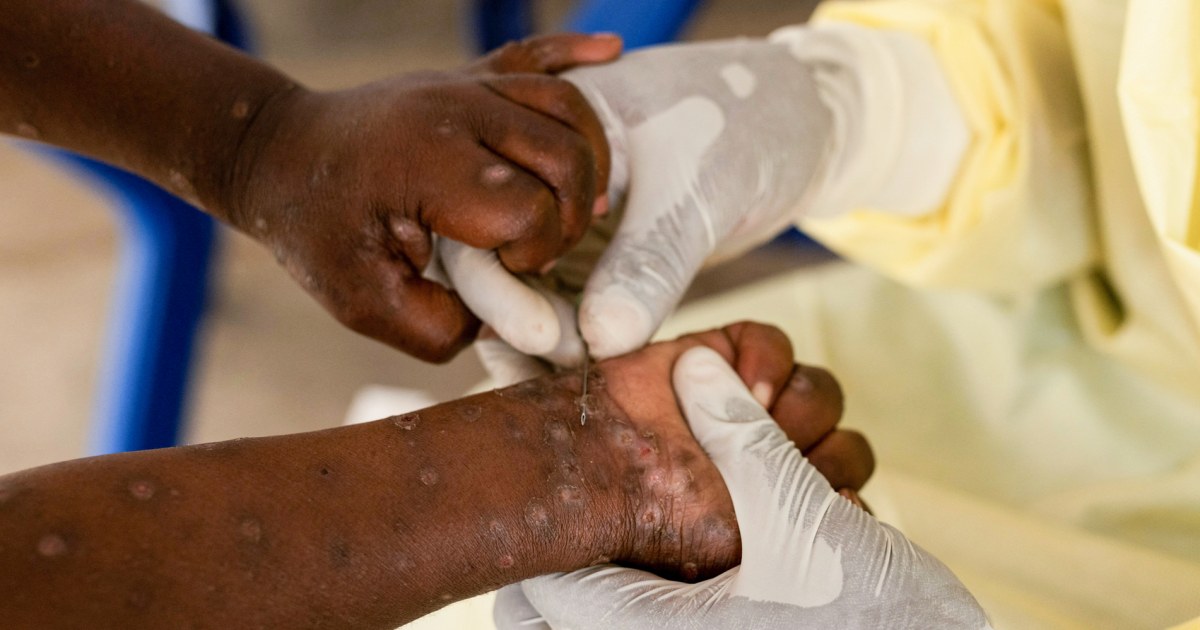 The mpox strain spreading now is different from the one in 2022: Here’s what to know