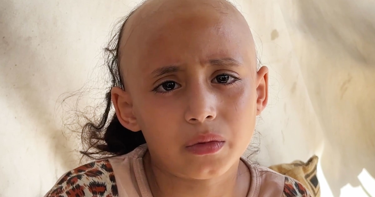 Sama, 8, Suffers Psychological Damage and Loses Hair