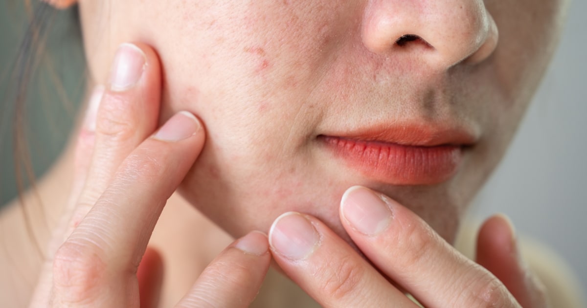 Pore vacuums are trending — dermatologists share what to look for and how to use them