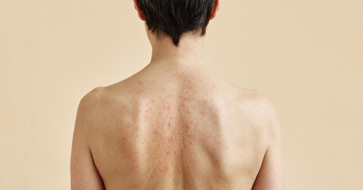 How to get rid of back acne, according to dermatologists