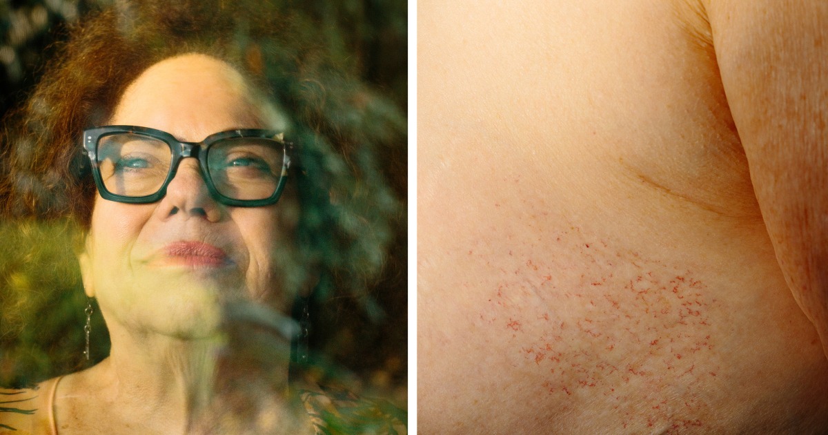 U.S. women are increasingly shut out of a breast cancer treatment valued around the world