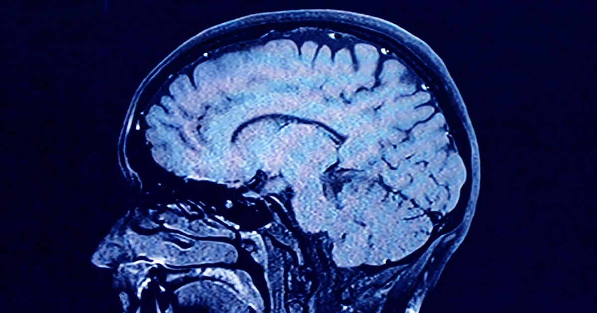 Human Brains Have 5 Distinct 'epochs' In A Lifetime, Study Finds