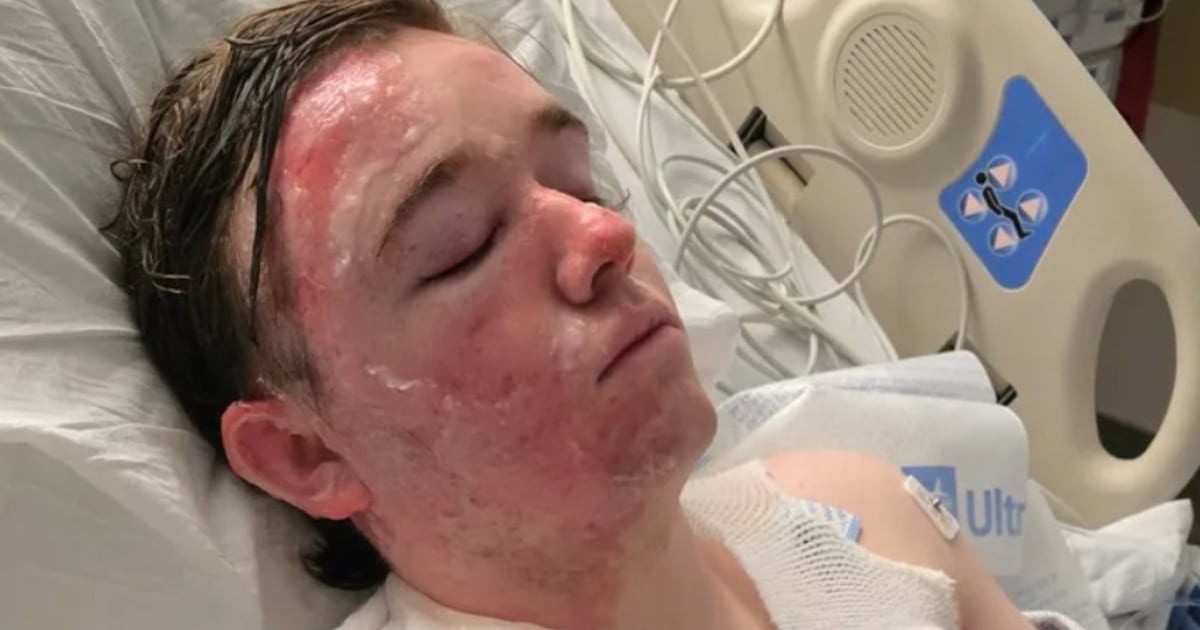 McDonald’s worker suffers severe burns on face and body after coworker throws hot oil on him, family says McDonald’s worker suffers severe burns on face and body after coworker throws hot oil on him, family says